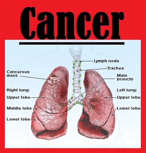 About Lung Cancer 3000 Lung Cancer Survival Rate