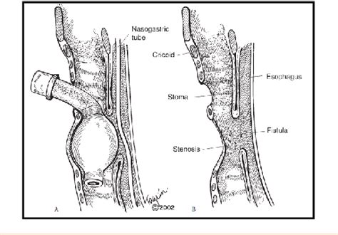 [pdf] Tracheoesophageal Fistula A Complication Of Prolonged Tracheal