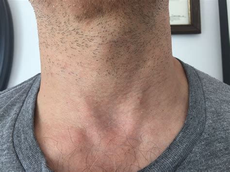 thyroid  surgery  fix  large symptomatic  ugly goiter nodules   thyroid rfa