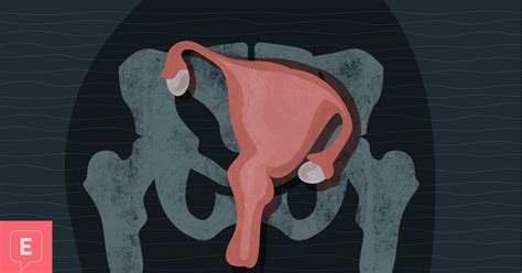 Why A Displaced Uterus Might Be Causing Me Pain