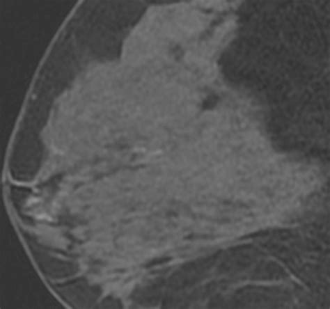 ductal carcinoma in situ of the breast mr imaging findings with