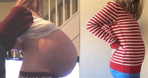 woman s three year pregnancy was actually 57 pound cyst