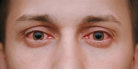 indications  eye problems signs symptoms neoretina