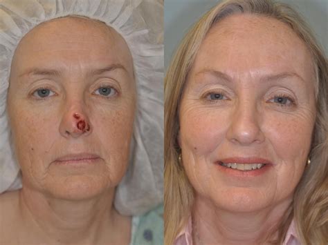 mohs reconstruction  forehead flap