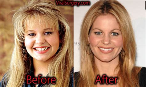 Candace Cameron Plastic Surgery Before After Botox Pictures