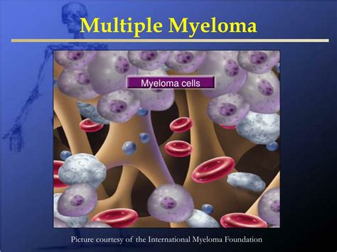 metastatic bone disease  multiple myeloma powerpoint