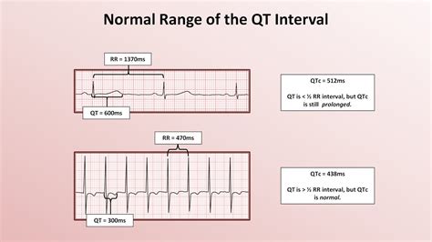 advanced ekgs  qt interval  long qt syndrome youtube