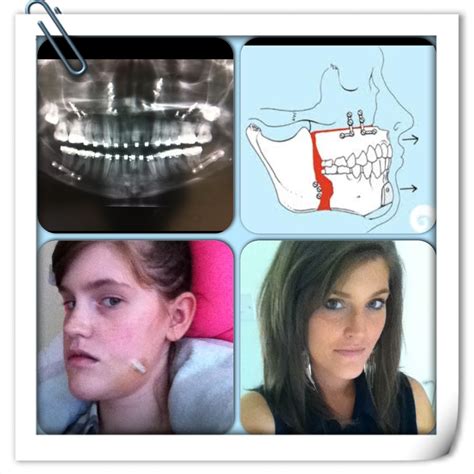 A Guide To Surviving Orthognathic Surgery Before And