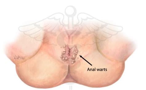 about anal genetal warts quality porn