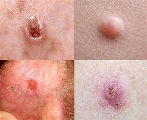 Skin Cancer Types Pics