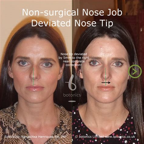 surgical nose job    comparison  london uk