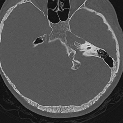 Wormian Bones Osteogenesis Imperfecta Image