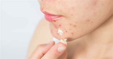 What To Do After Popping A Pimple Tips And Treatments Popsugar Beauty