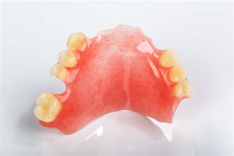 plaatprothese gedeeltelijke prothese noordzij tandprothetiek