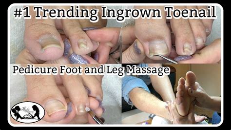 trending ingrown toenail cleaning pedicure foot massage  nail