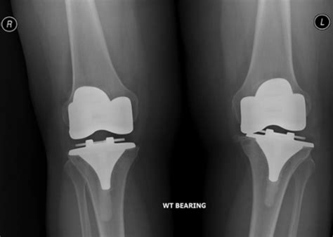 investigation  revision knee replacement   failed tkr