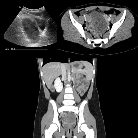 pediatric ovarian torsion pediatric radiology reference article pediatric imaging atpedsimaging