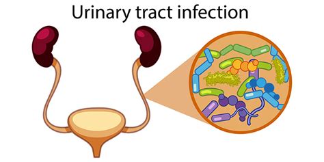 Urinary Tract Infections Uti Symptoms Types Causes And Treatment