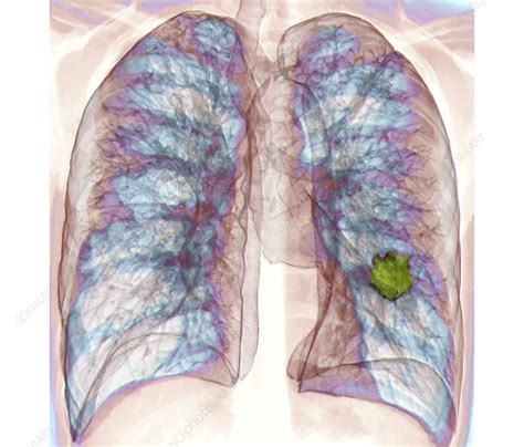 Lung Cancer 3d Ct Scan Stock Image C021 2257