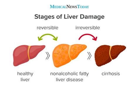 Fatty Liver Disease Symptoms Causes Risks And Treatment