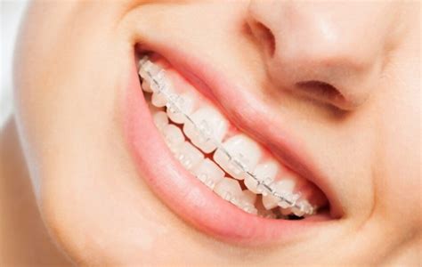 The Average Cost Of Braces Vs Invisalign The Orthodontic Place