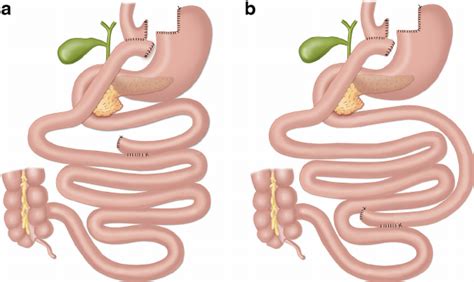 Anatomical Differences Between A Proximal Gastric Bypass And B Distal