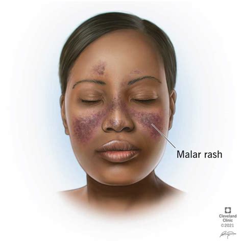lupus rash types  treatment prevention