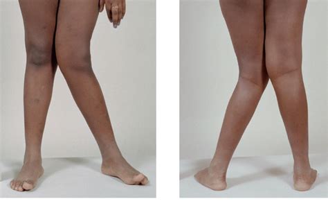deformity   knee   proprofs discuss