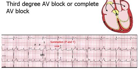 3rd Degree Av Block Login Cardiac And Vascular Pinterest