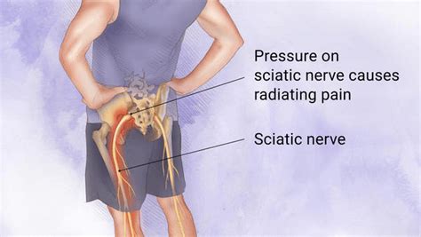 sciatica treatment balanced body acupuncture and chiropractic omaha