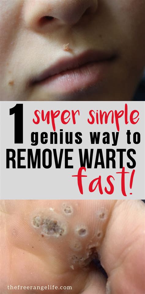 rid  warts quickly naturally    rid  warts warts  face warts
