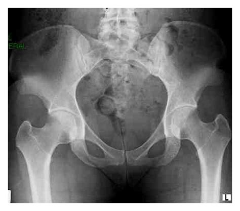 Chondrolysis Of The Hip Following Septic Arthritis A Rare Complication