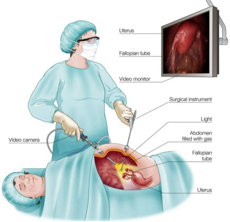 Laparoscopic Gynecological Surgery Cost In Bangalore Find The Best