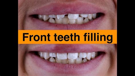 Front Teeth Filling Youtube