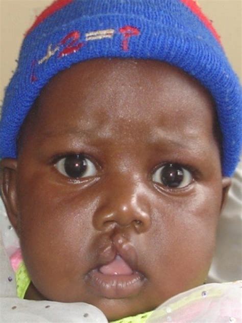 patients  cleft issues  benefit   surgery