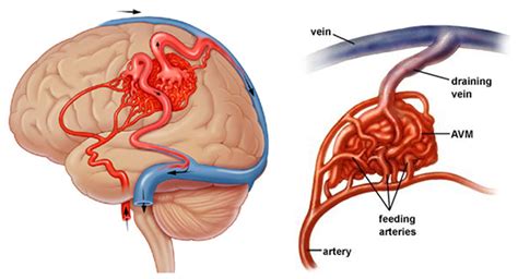 brain vascular malformation symptoms treatment pacific stroke