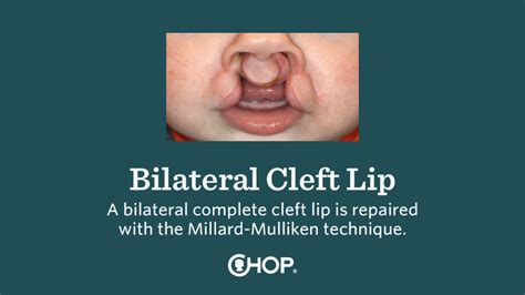 Bilateral Cleft Lip Repair Surgical Tutorial For Professionals