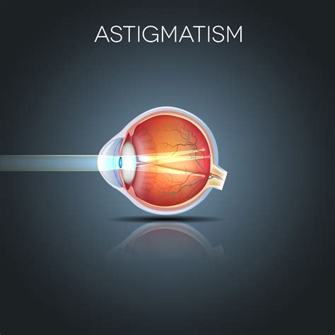 ten     astigmatism  vision guide