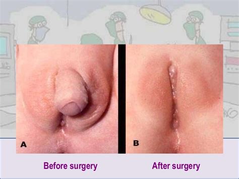 Intersex genitalia photos