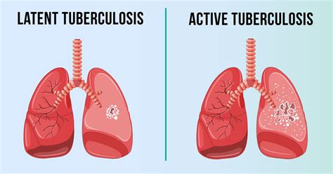 tuberculosis tb types symptoms   prevention remedy space