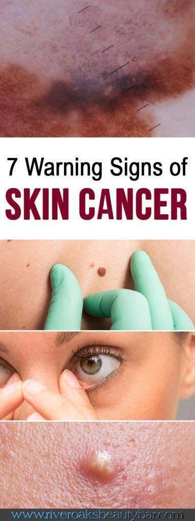 7 Skin Cancer Warning Signs You Should Never Ignore Healthy Lifestyle