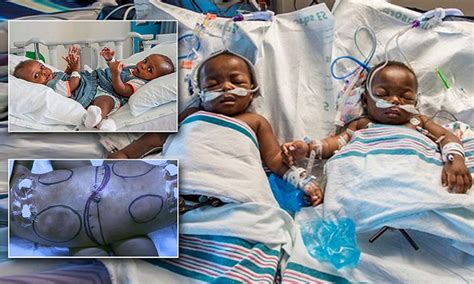 Conjoined Twin Girls From Nigeria Separated At Us Hospital