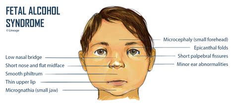 fetal alcohol syndrome pediatrics medbullets step 2 3