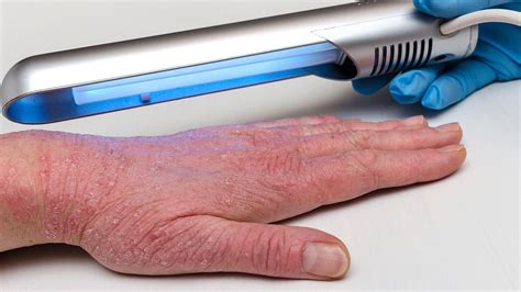 uvb light therapy  psoriasis reviews shelly lighting