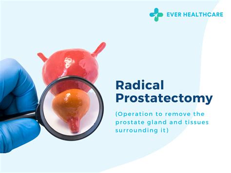 Radical Prostatectomy In Thailand 2022 Compare Price And Reviews Ever