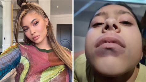 Kylie Jenner Lip Challenge Leads To Girl’s Shock Diagnosis 7news