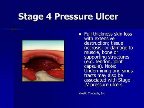 stage  pressure ulcer sacrum