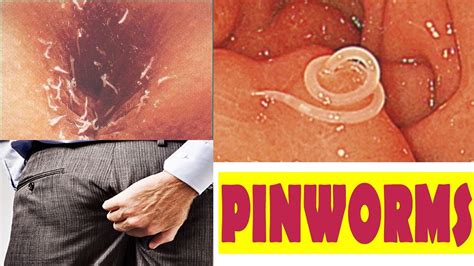 itching problem in private parts type cause and natural treatment