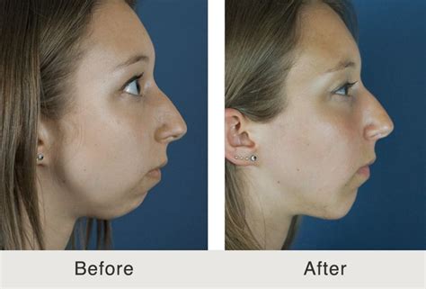 Before And After Chin Implant Carolina Facial Plastics