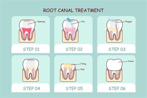 root canals safe  root canals  cancer sarasota dentistry